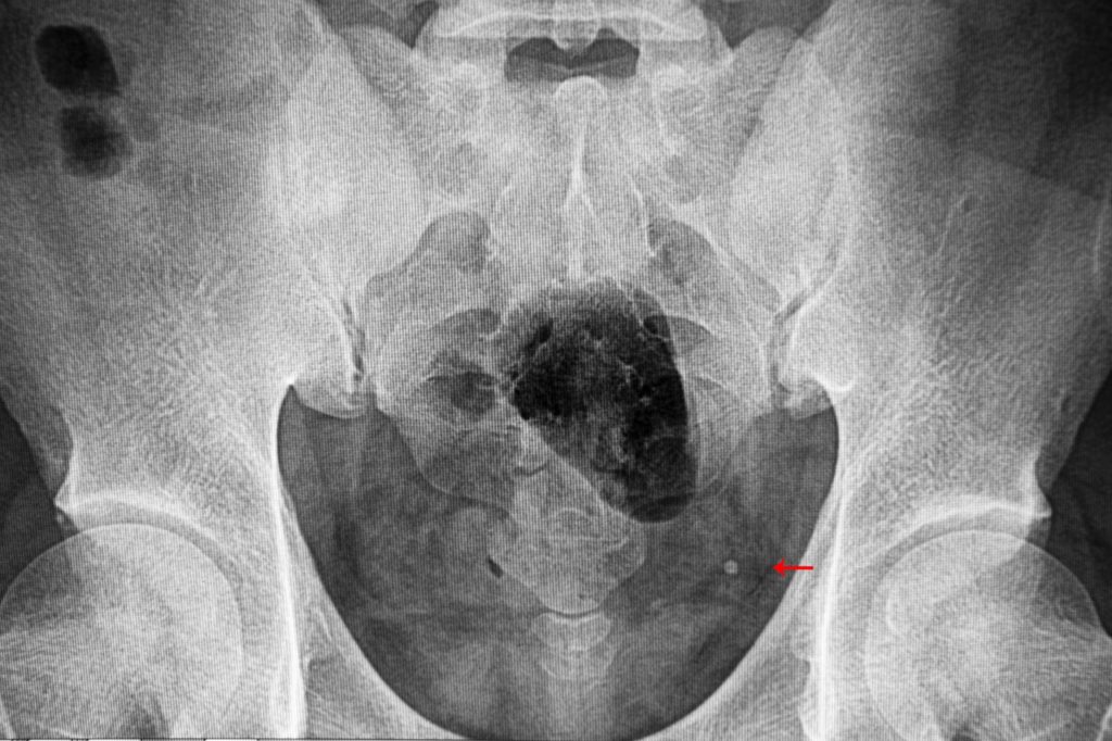 X-ray revealing bladder stones