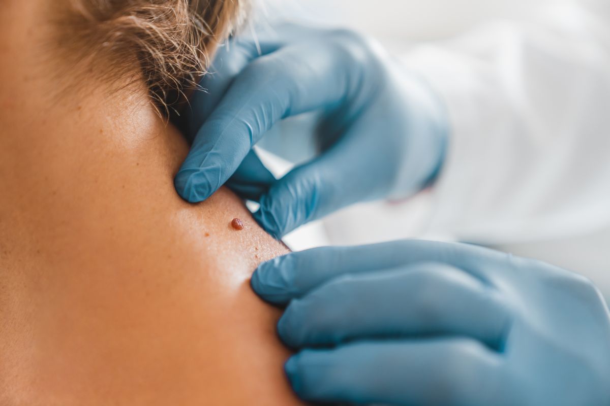 Close Up Of Dermatologist Examining Patient Birthm 2022 06 21 17 53 55 Utc (1)